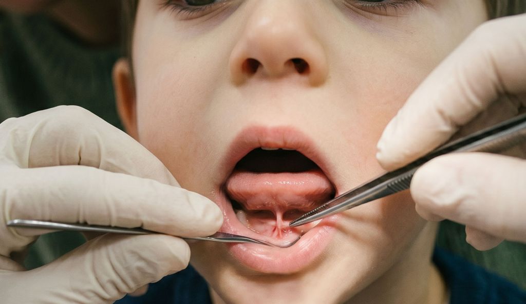 Functional frenuloplasty. Frenuloplastia funcional,La anquiloglosia, o frenillo lingual corto. Breathe Clinic Madrid airway centred dentistry